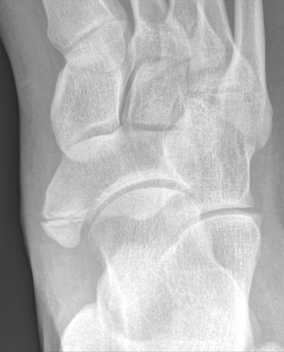 X-ray에서 주상골 안쪽에 붙어 보이는 부주상골